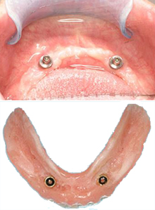 Photo of affordable dental implants, snap-on dentures from Pasadena dentist Dr. Arash Azarbal.
