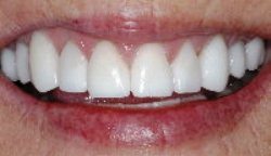 After photo of Pasadena metal-free crowns, which are available from Dr. Arash Azarbal.