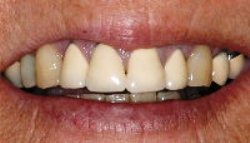 Before photo of Pasadena metal-free crowns, which are available from Dr. Arash Azarbal.