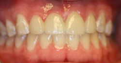 After photo of porcelain bridge from Pasadena cosmetic dentist Dr. Arash Azarbal.