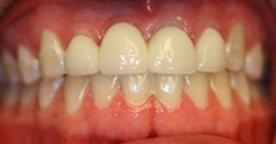 Before photo of porcelain bridge from Pasadena cosmetic dentist Dr. Arash Azarbal.