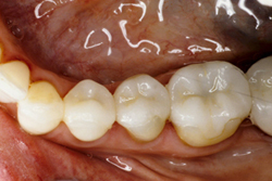 After photo of porcelain onlay from Pasadena cosmetic dentist Dr. Arash Azarbal.