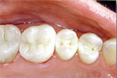 After photo of tooth filling from mercury-free dentist Dr. Arash Azarbal.