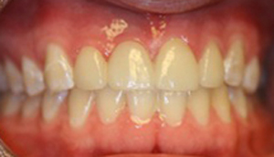 Close-up photo of patient after receiving an all-porcelain bridge from Pasadena dentist Dr. Arash Azarbal.