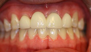 Close-up photo of patient before receiving an all-porcelain bridge from Pasadena dentist Dr. Arash Azarbal.