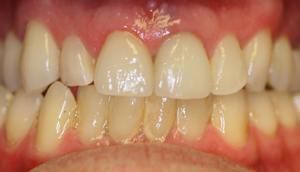 Close-up photo of patient after receiving porcelain crowns from Pasadena dentist Dr. Arash Azarbal.