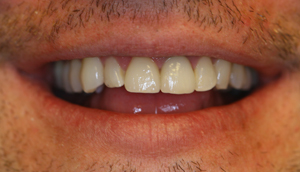 Second close-up photo of patient after receiving porcelain crowns from Pasadena dentist Dr. Arash Azarbal.