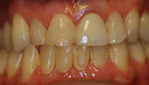 Close-up photo of patient before receiving porcelain crowns from Pasadena dentist Dr. Arash Azarbal.