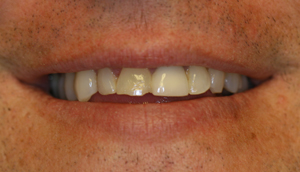 Close-up photo of patient before receiving porcelain crowns from Pasadena dentist Dr. Arash Azarbal.