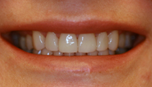 After picture of patient (P) for porcelain veneers from Pasadena dentist Dr. Arash Azarbal.