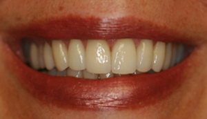 After picture of patient (M) for porcelain veneers from Pasadena dentist Dr. Arash Azarbal.
