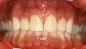 Close-up photo of patient after receiving porcelain veneers from Pasadena dentist Dr. Arash Azarbal.
