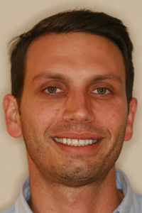 pasadena-porcelain-veneers-after-ff