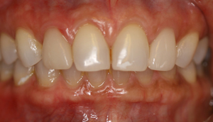 After picture of fractured porcelain veneer that was repaired by Pasadena dentist Dr. Arash Azarbal.