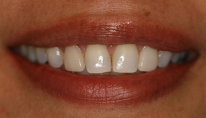 Second after picture of fractured porcelain veneer that was repaired by Pasadena dentist Dr. Arash Azarbal.