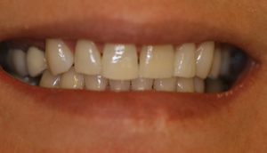 Before picture of patient (P) prior to receiving porcelain veneers from Pasadena dentist Dr. Arash Azarbal.