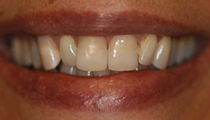 Before picture of patient (M) prior to receiving porcelain veneers from Pasadena dentist Dr. Arash Azarbal.