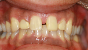 Close-up photo of patient before receiving porcelain veneers from Pasadena dentist Dr. Arash Azarbal.