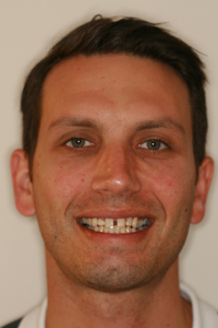 Full-face photo of patient before receiving porcelain veneers from Pasadena dentist Dr. Arash Azarbal.