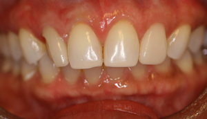Before picture of fractured porcelain veneer that was repaired by Pasadena dentist Dr. Arash Azarbal.