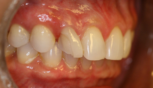 Second before picture of fractured porcelain veneer that was repaired by Pasadena dentist Dr. Arash Azarbal.