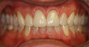 After picture of porcelain veneers (CY) from Pasadena dentist Dr. Arash Azarbal.