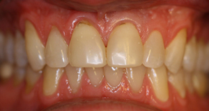 Porcelain veneers before picture (CY) from Pasadena dentist Dr. Arash Azarbal.