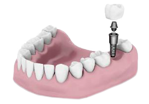 dental implant